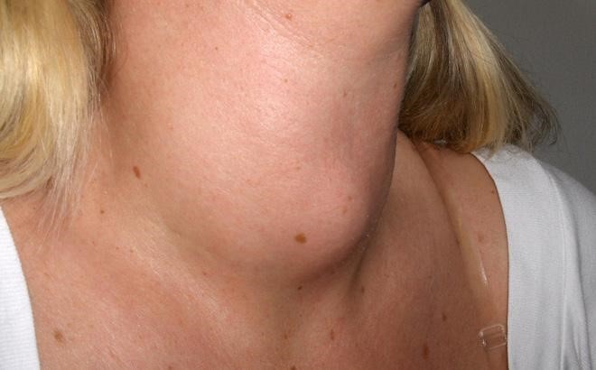 Bướu cổ mà mọi người thường gặp